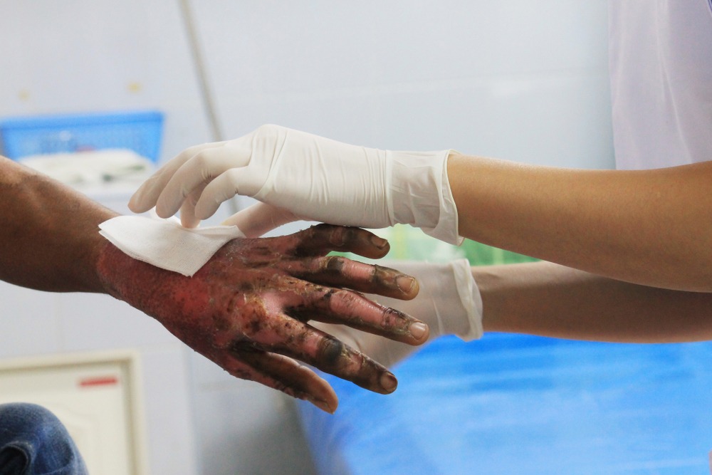 Burn Injuries Lawyer